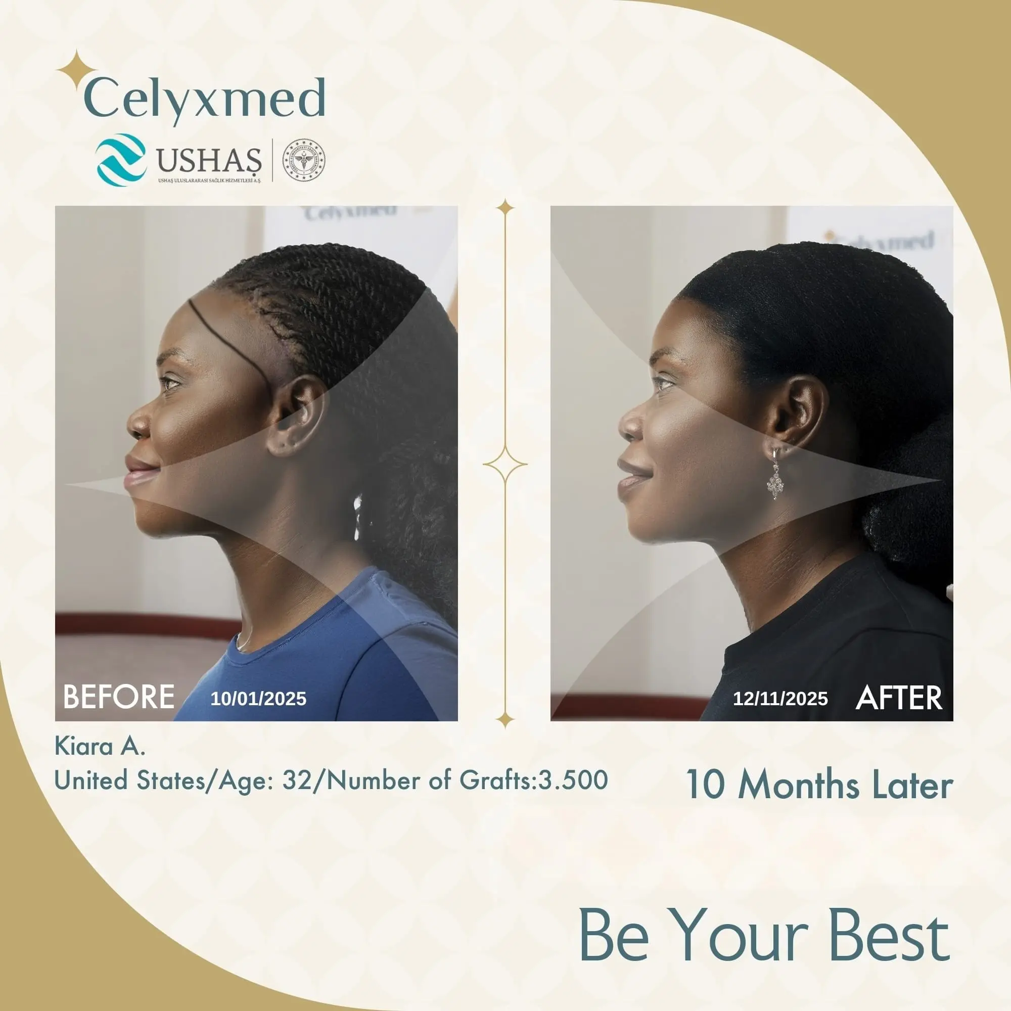Afro Haartransplantation in der Türkei