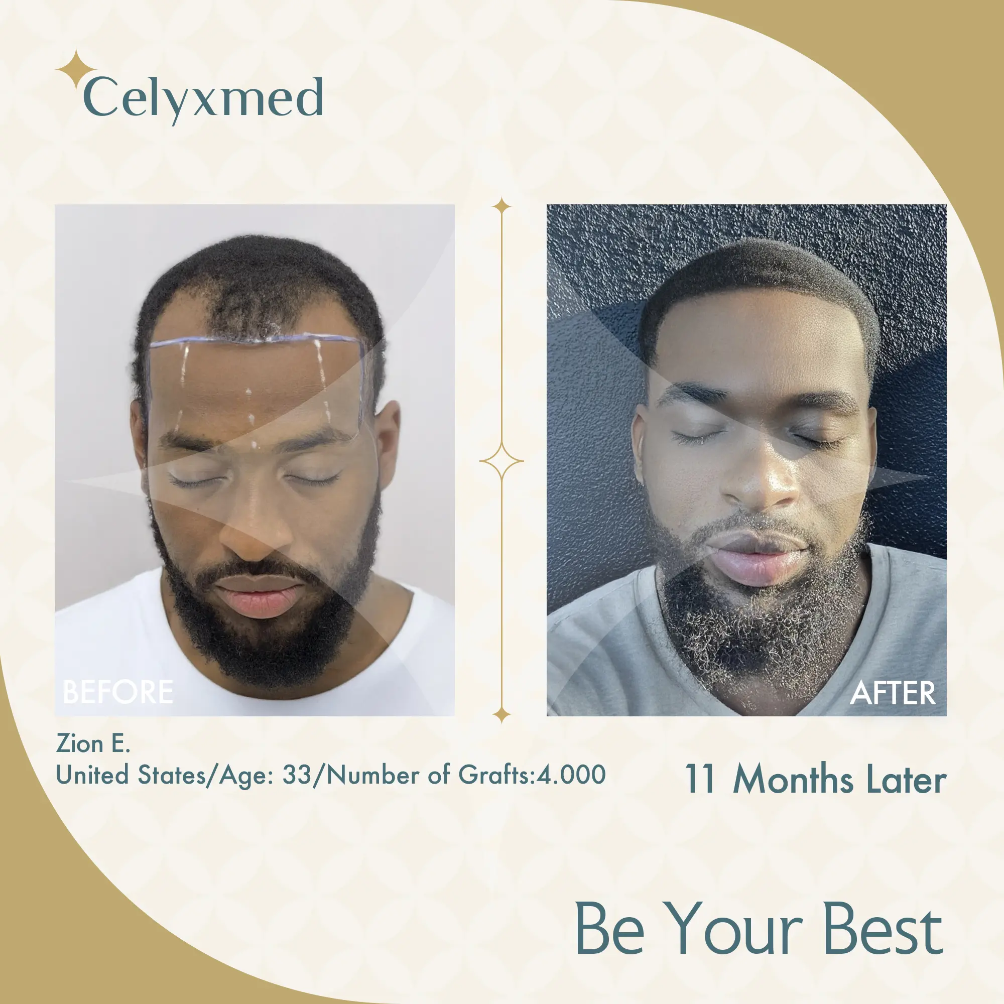 Afro Amerikan Saç Ekimi Türkiye