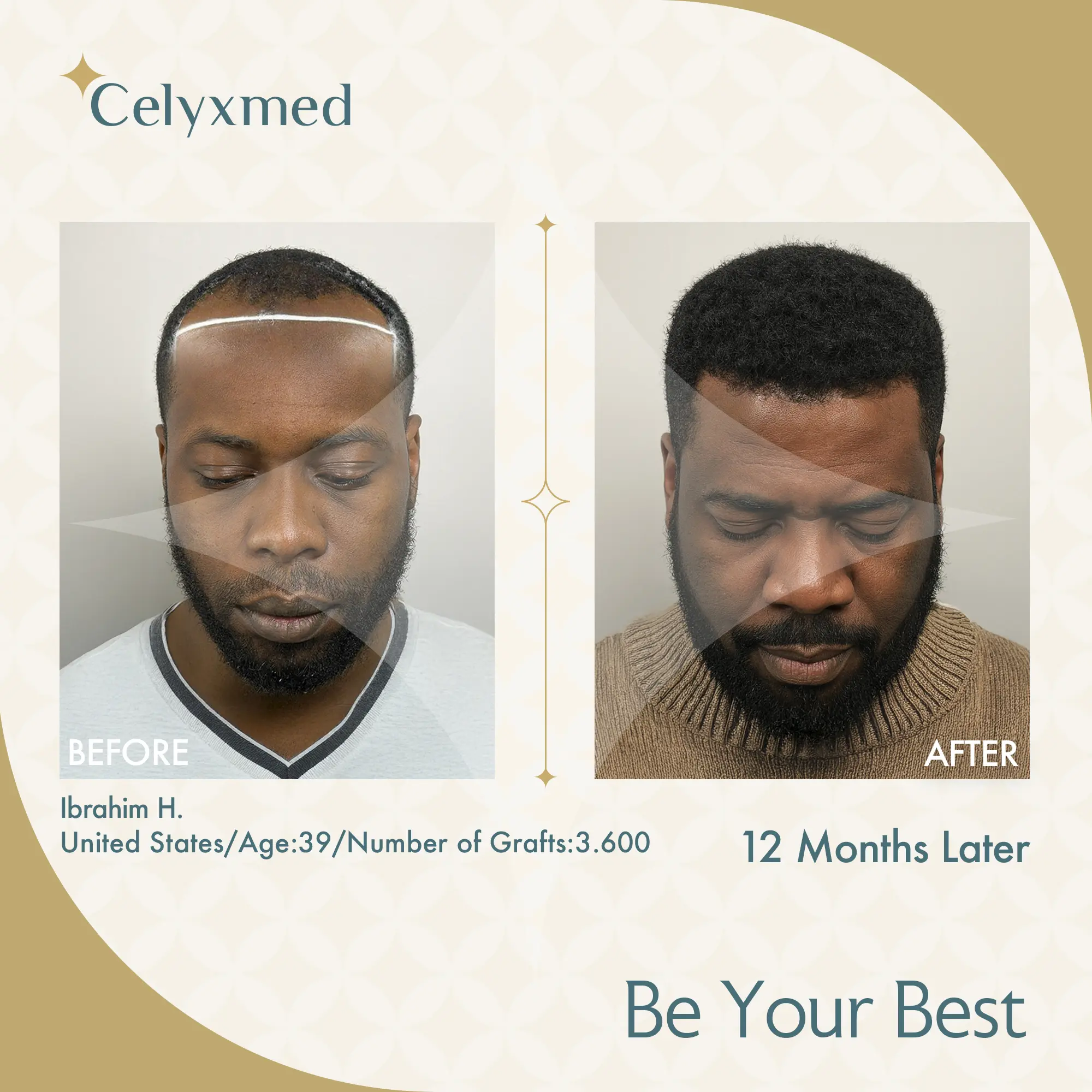 Afro Amerikan Saç Ekimi Türkiye