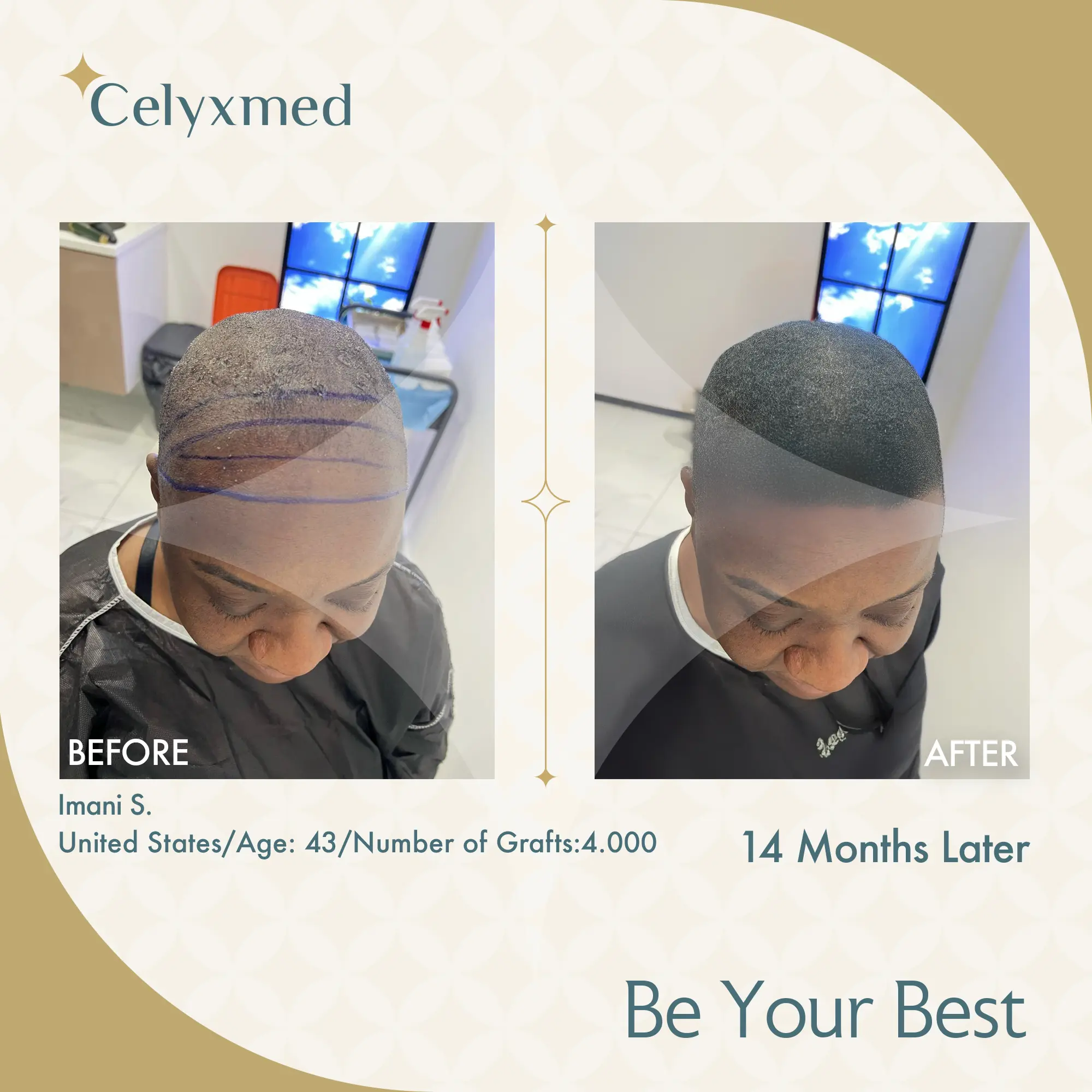 Afro Amerikan Saç Ekimi Türkiye