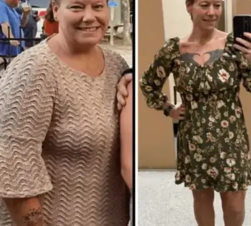 Türkiye'de yüz germe ameliyatı