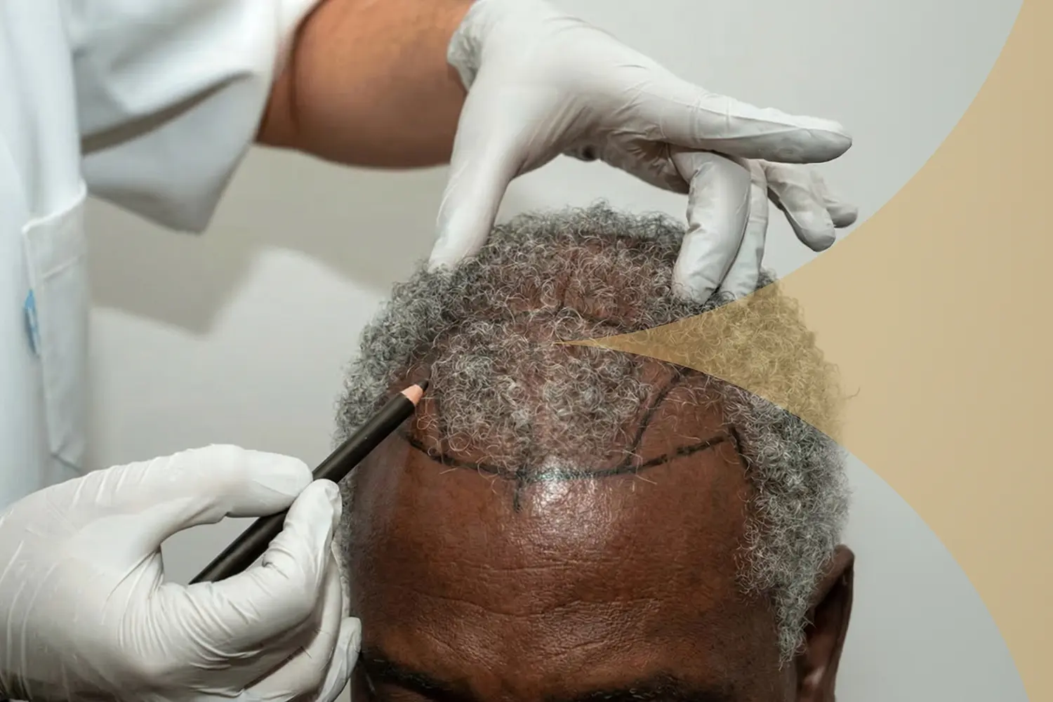 Afro Haartransplantation in der Türkei