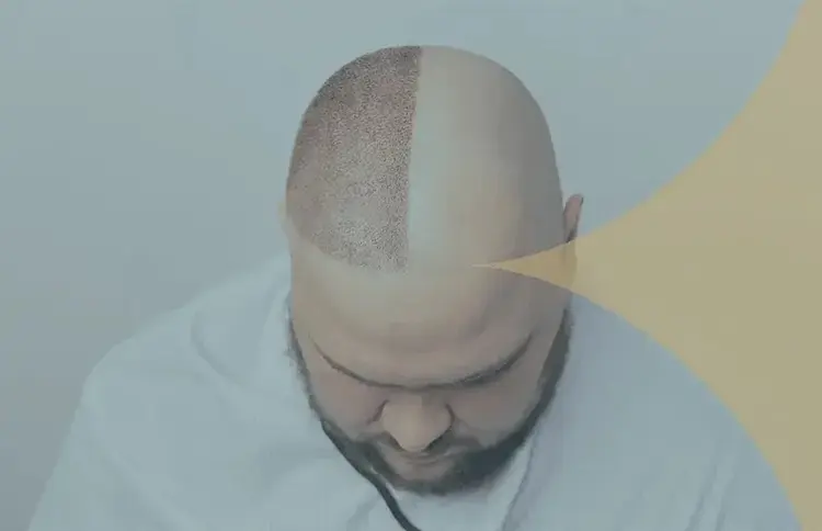 FUE Hair Transplant in Turkey