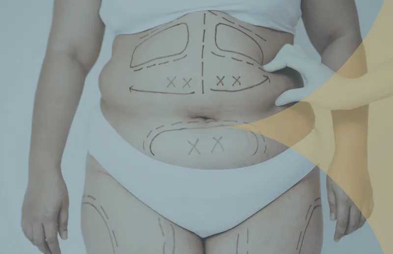 Liposuction in Turkey