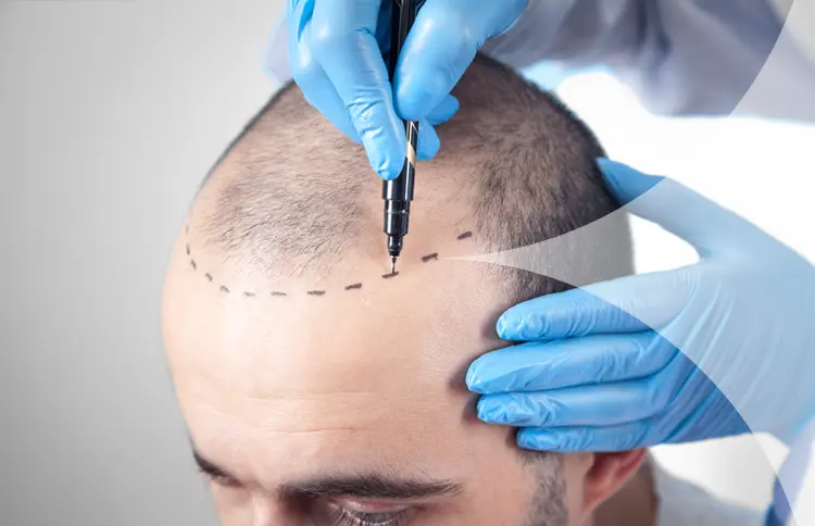 Hair Transplant in Turkey