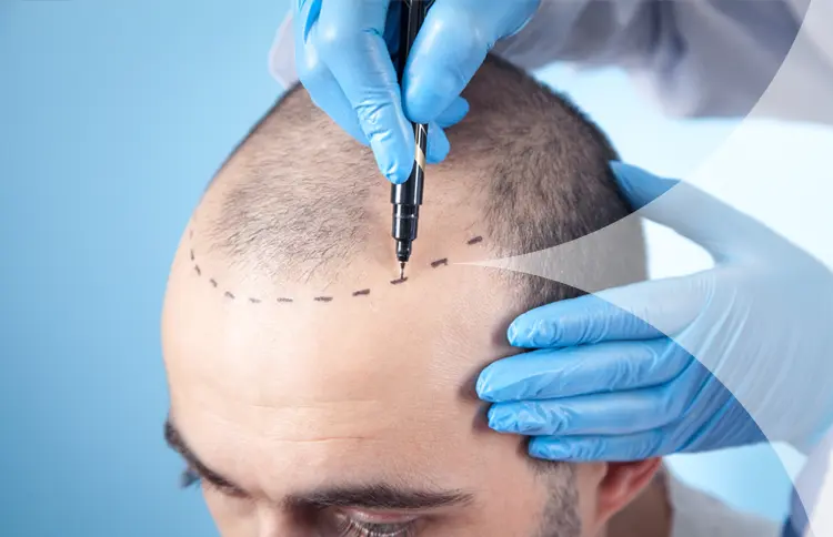 Hair Transplant
