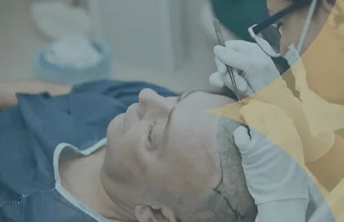 Haartransplantation in der Türkei