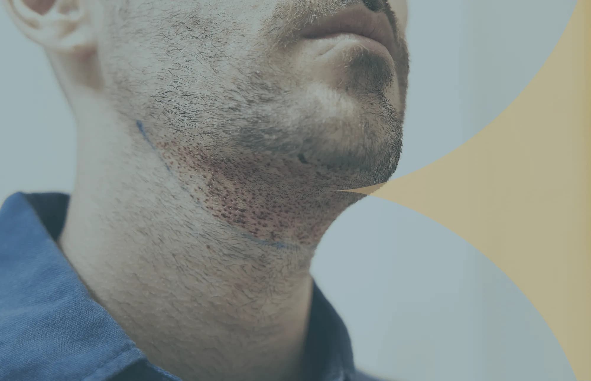 Barttransplantation in der Türkei