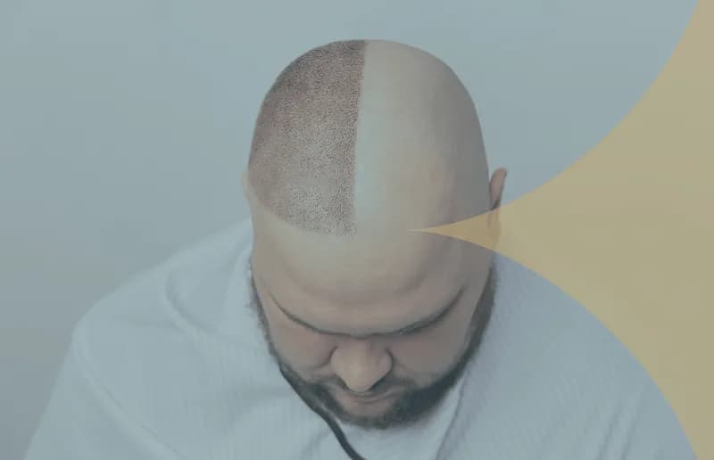 FUE-Haartransplantation in der Türkei